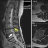 Doctors Gave Up Fixing This Woman’s Arthritis Back Pain, but Today She Feels Brand New