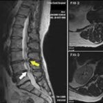Doctors Gave Up Fixing This Woman’s Arthritis Back Pain, but Today She Feels Brand New